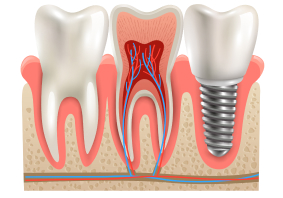 Root Canal Treatment